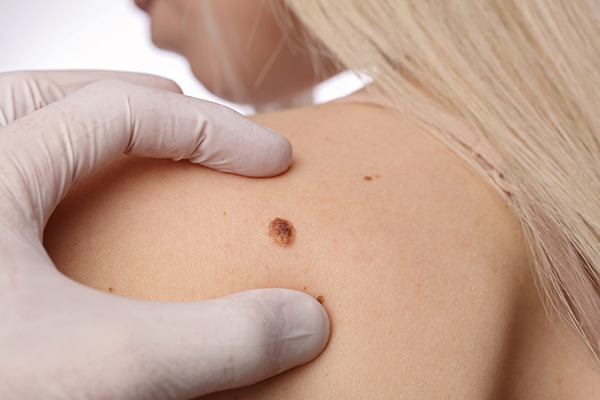 How To Remove Moles From Body - Making the incision can cause at least as much as the mole or in some cases,it can in this way, the protein value of the skin changes and help to fall the mole from the skin.